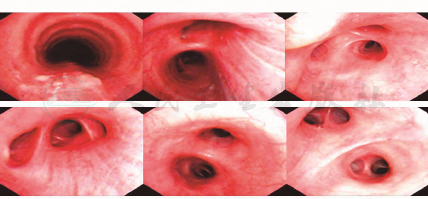 管腔内病变较前好转刷片未见肿瘤细胞,病理活检示(气管上段后壁)肉芽