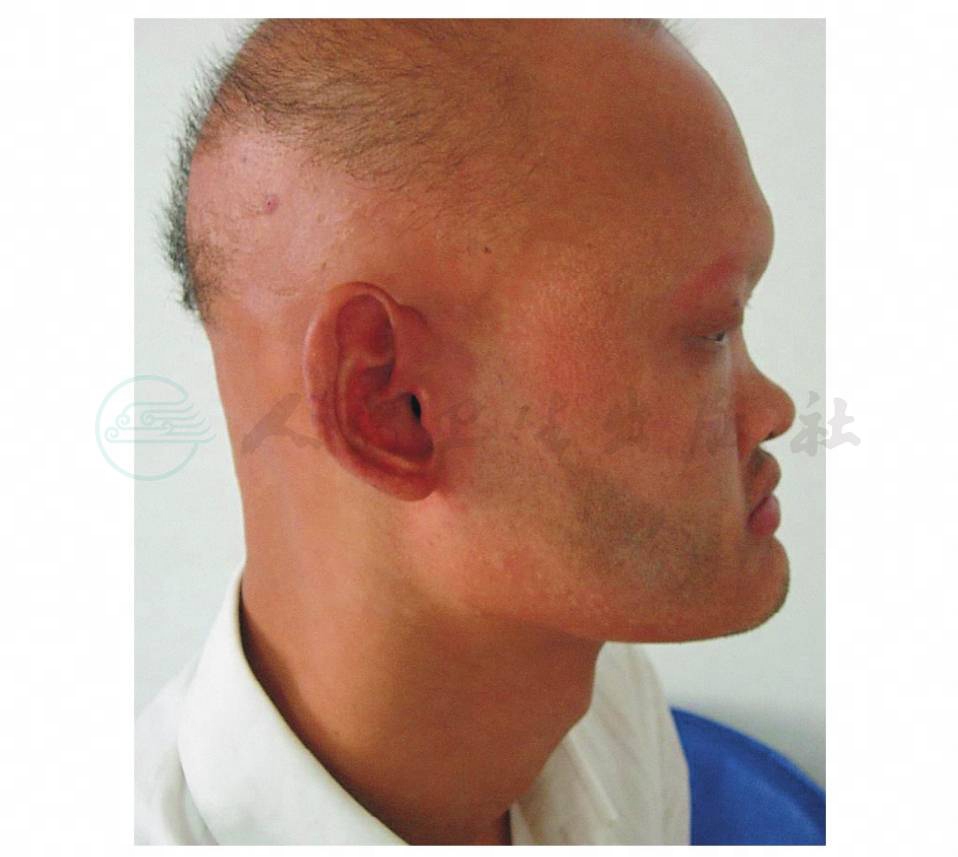 先天性外胚层发育不良