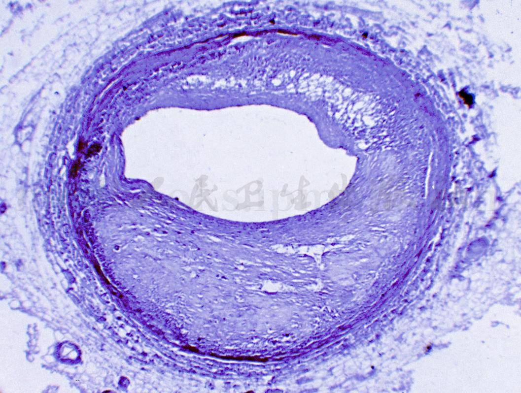 冠状动脉粥样硬化镜下图片