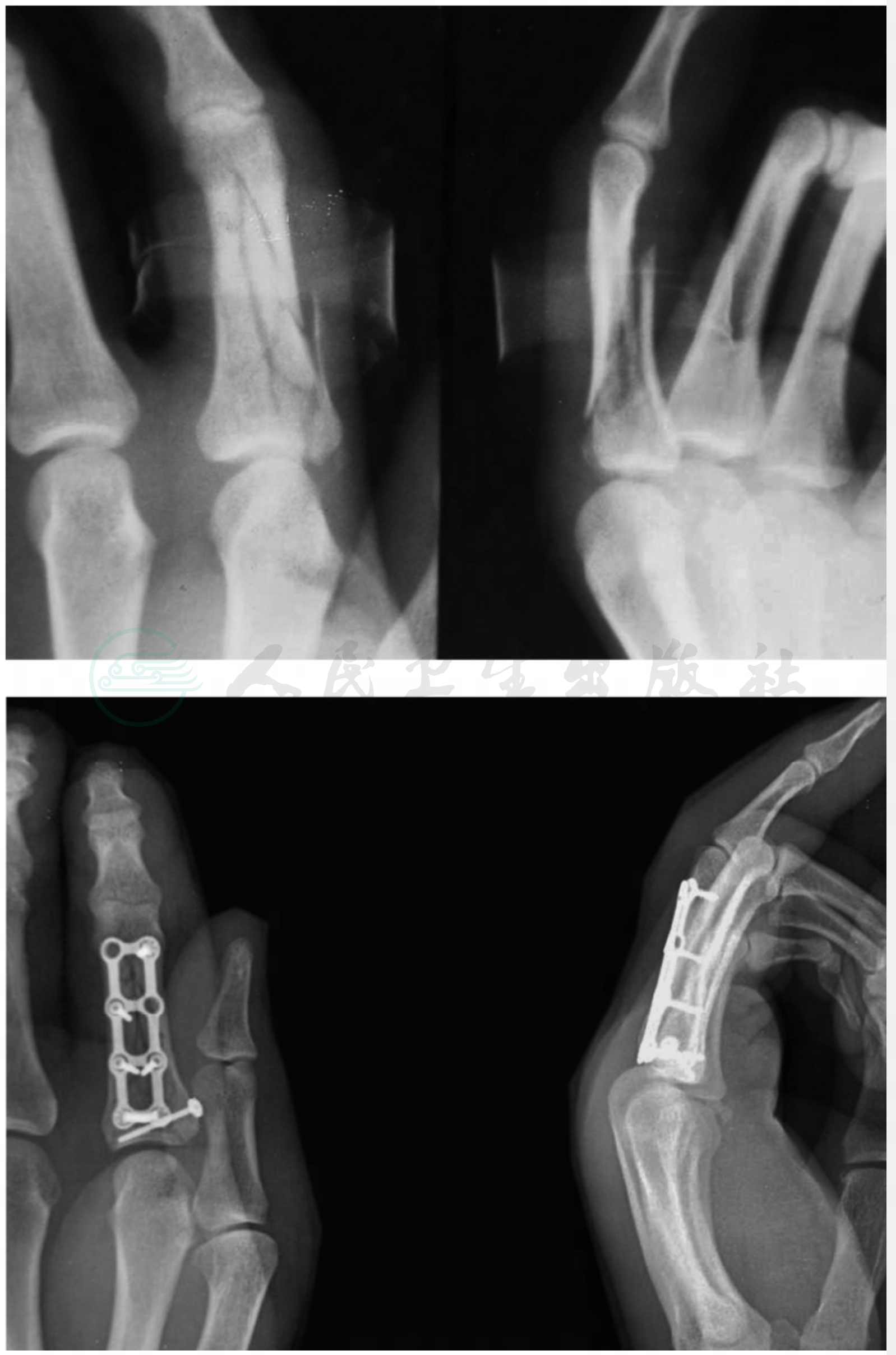 远侧指间关节离断图片图片