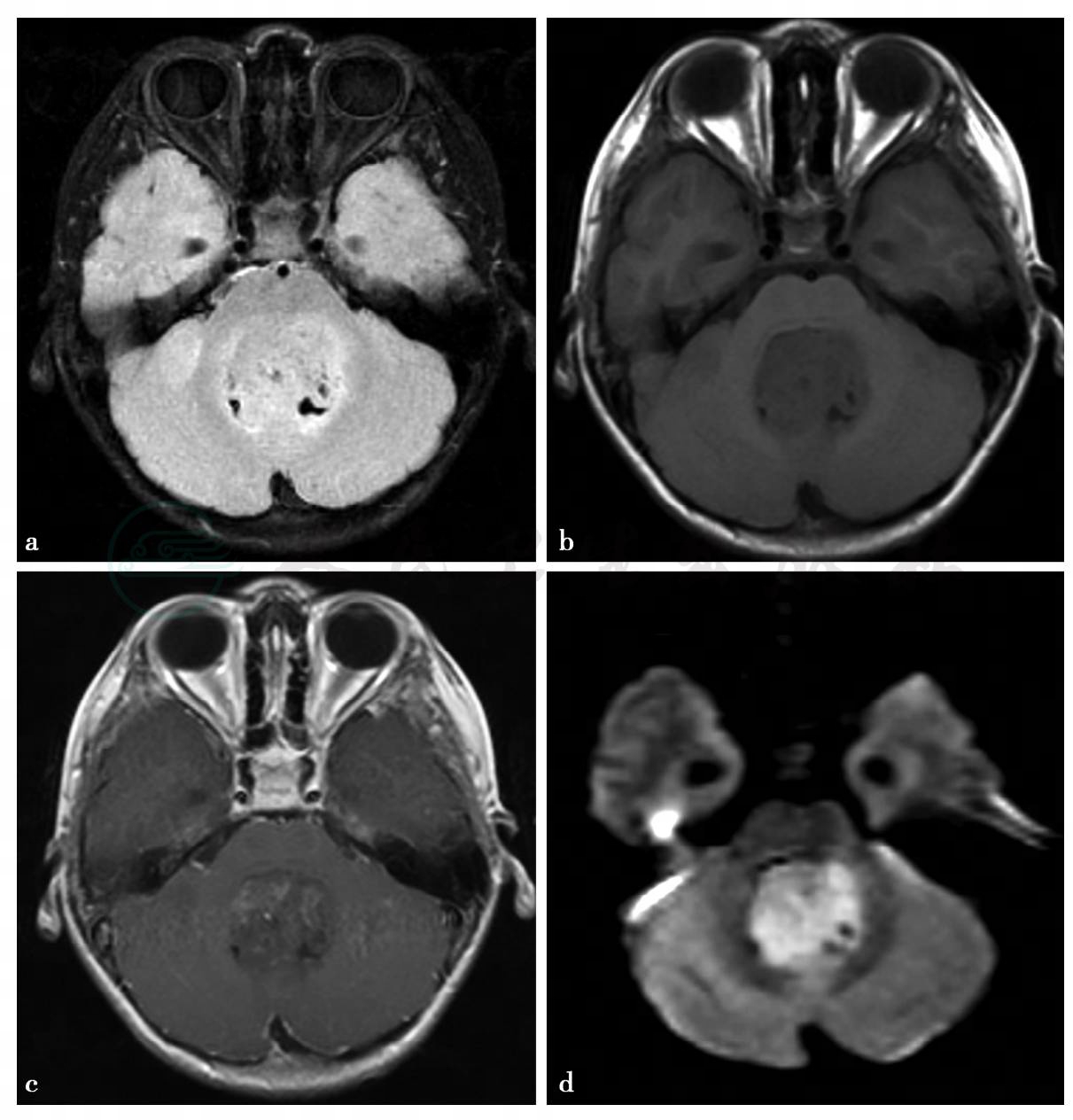 小脑蚓部髓母细胞瘤图片