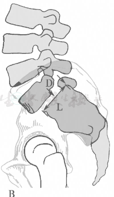 腰椎滑脱